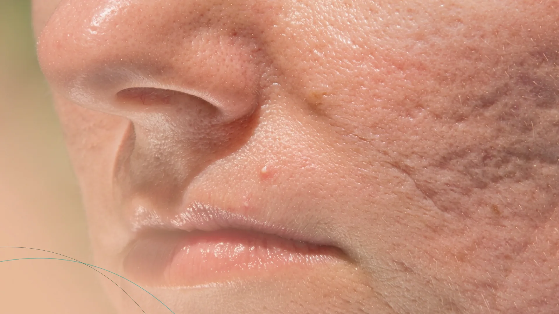 Dermapen cicatrices acne profundas