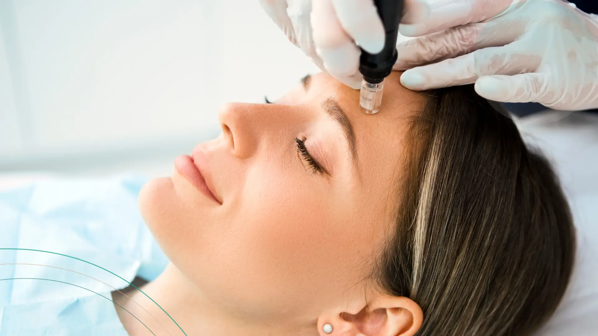 Dermapen cicatrices acne
