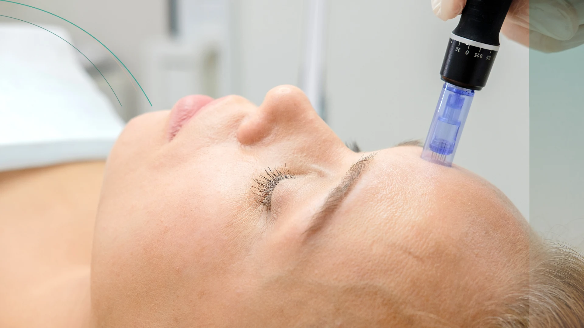 Dermapen contorno ojos