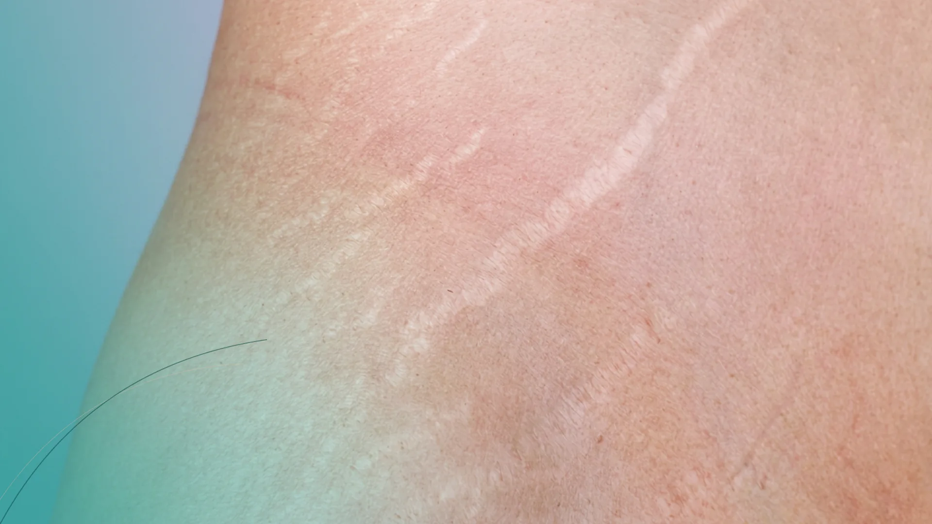 Dermapen estrias blancas