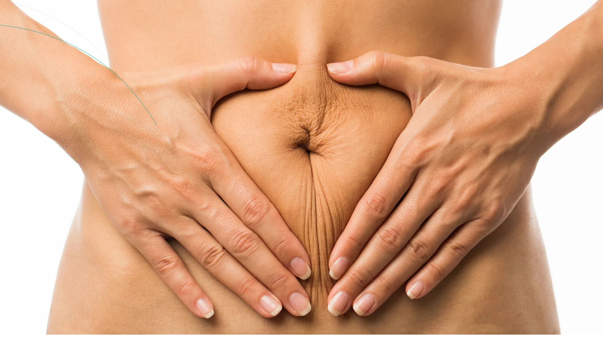 Dermapen estrias postparto