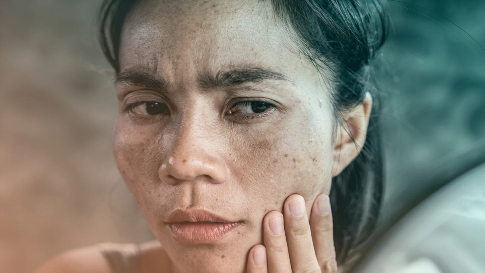 Dermapen manchas melasma facial