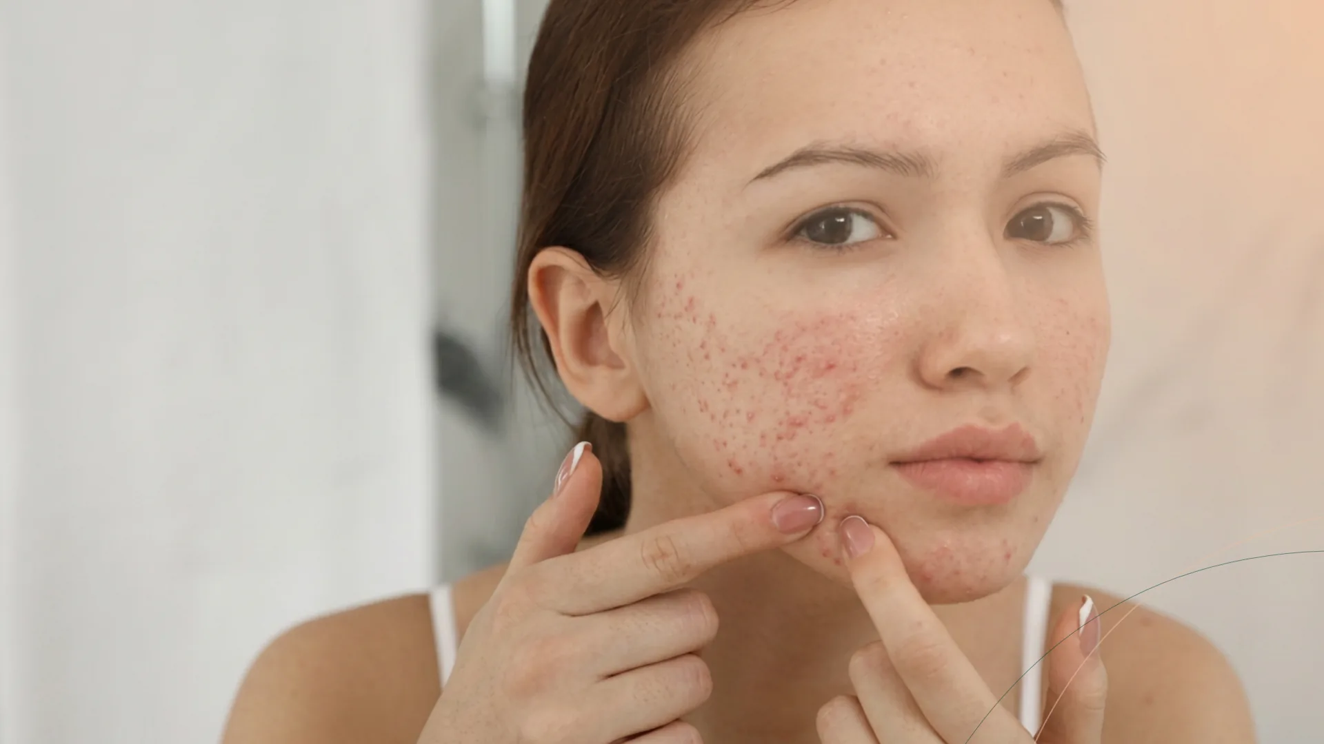 Dermapen marcas acne juvenil