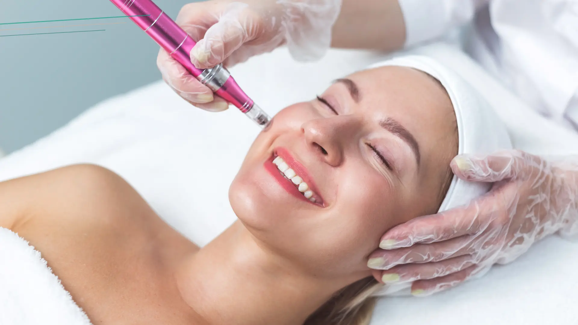 Dermapen rejuvenecimiento facial profesional