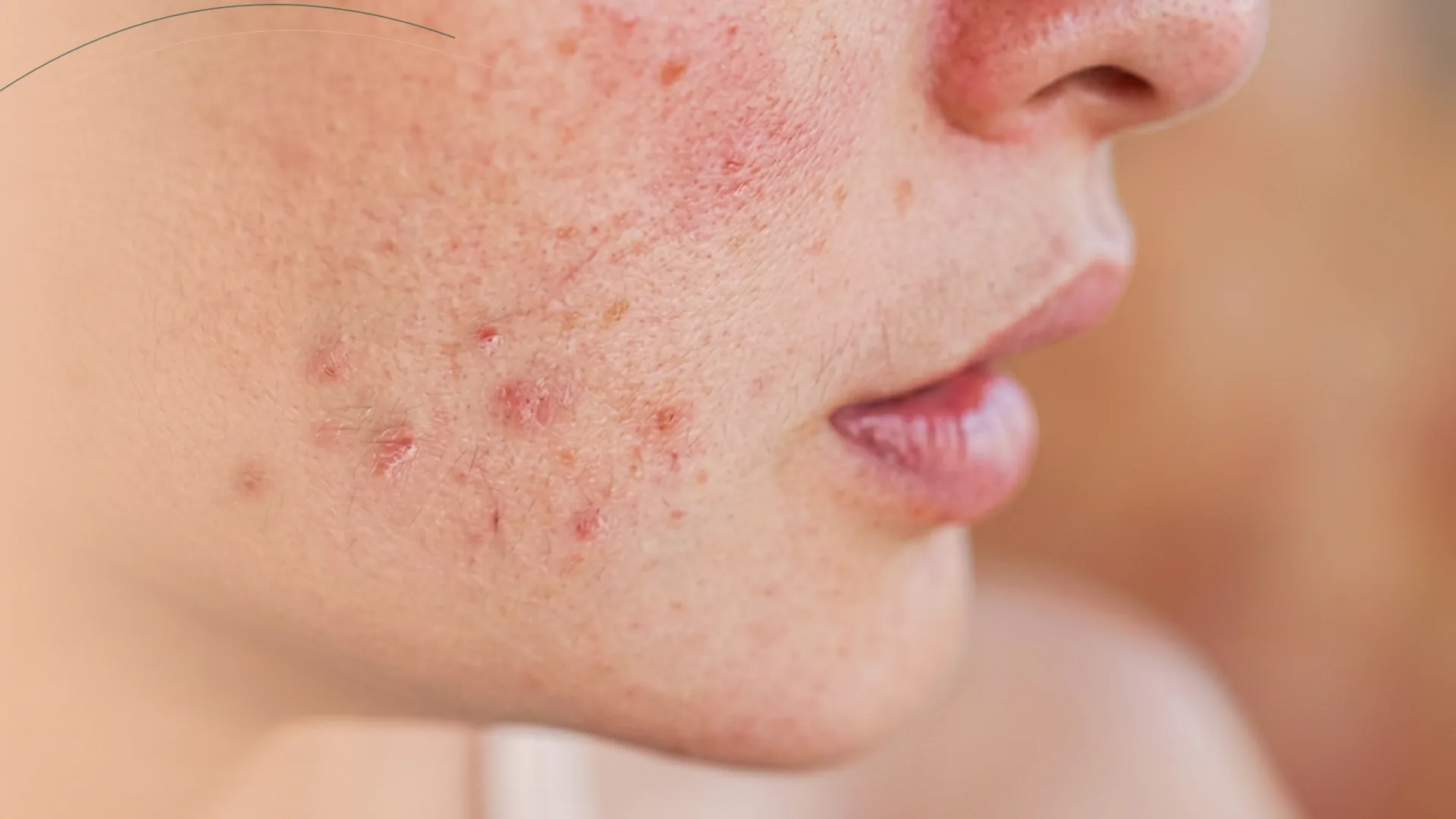 Microneedling acne activo marcas