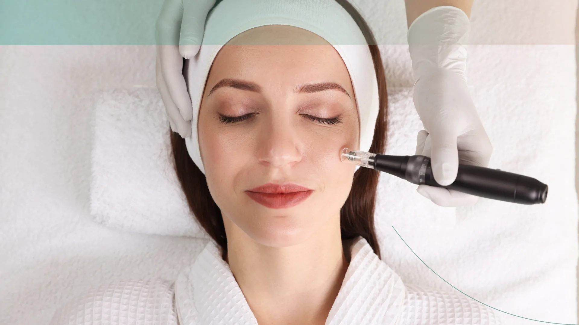 Microneedling capilar tratamiento caida cabello