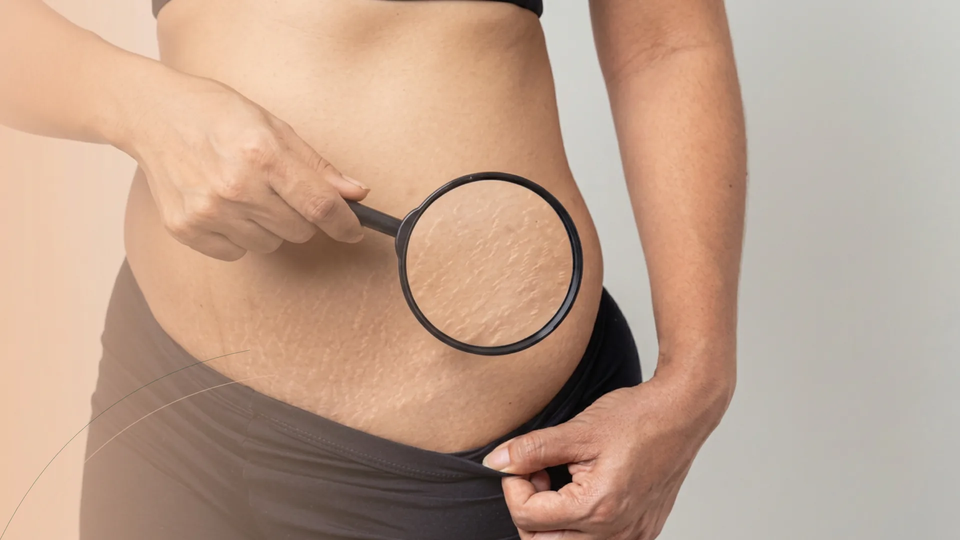Microneedling estrias corporales