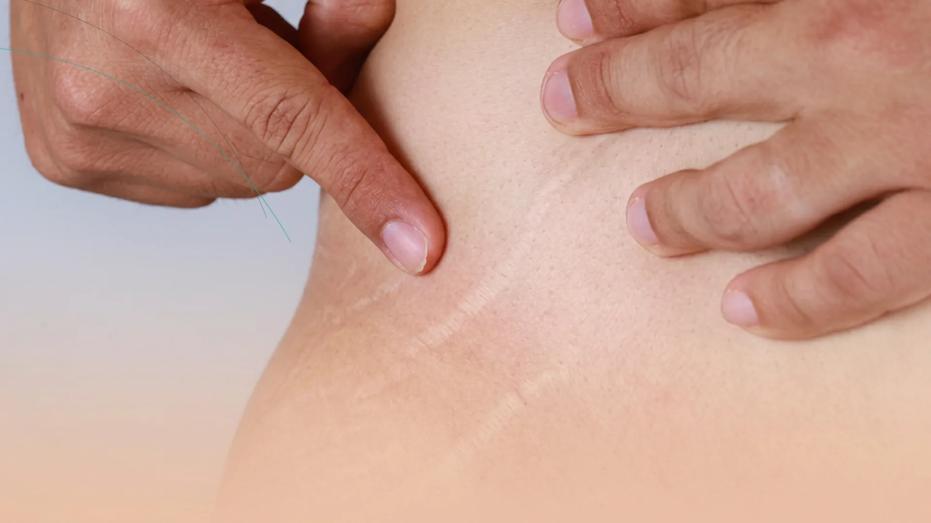 Microneedling estrias gluteos