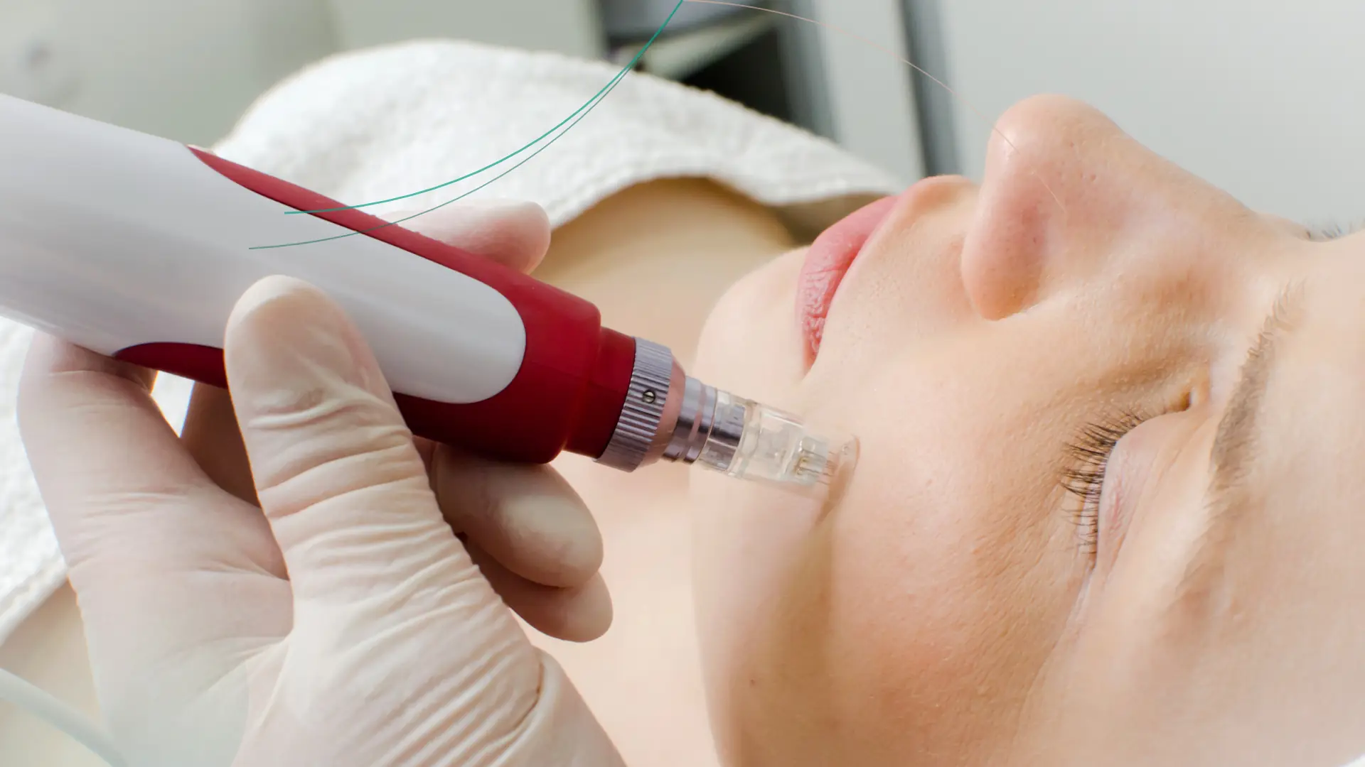 Microneedling facial profesional