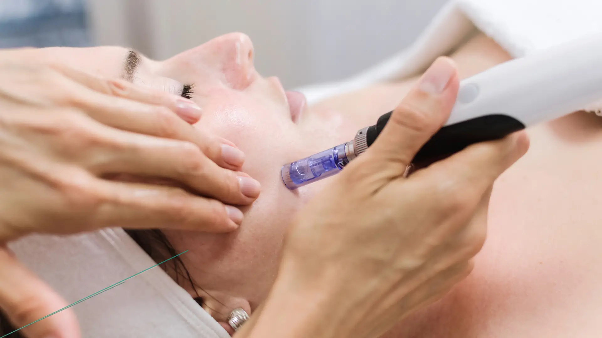 Microneedling frente lineas expresion