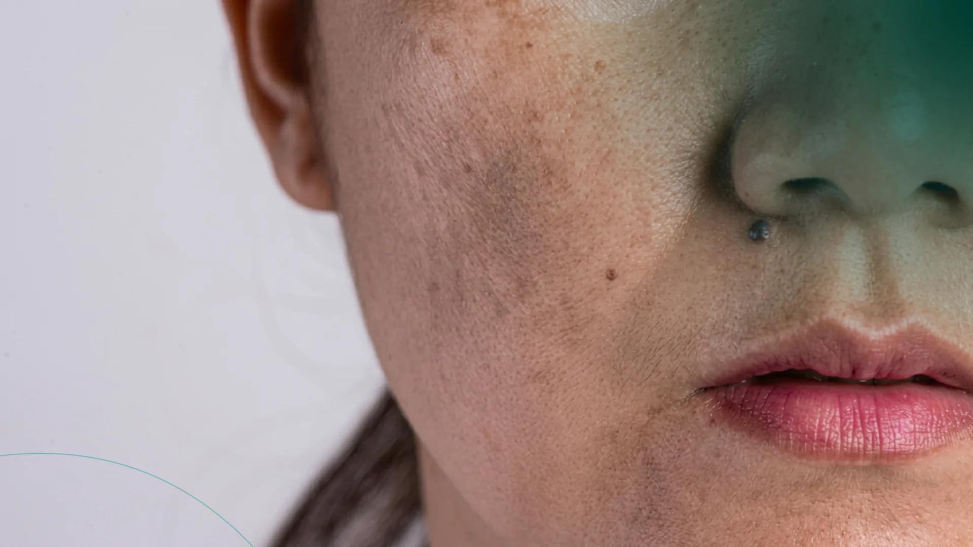 Microneedling hiperpigmentacion facial