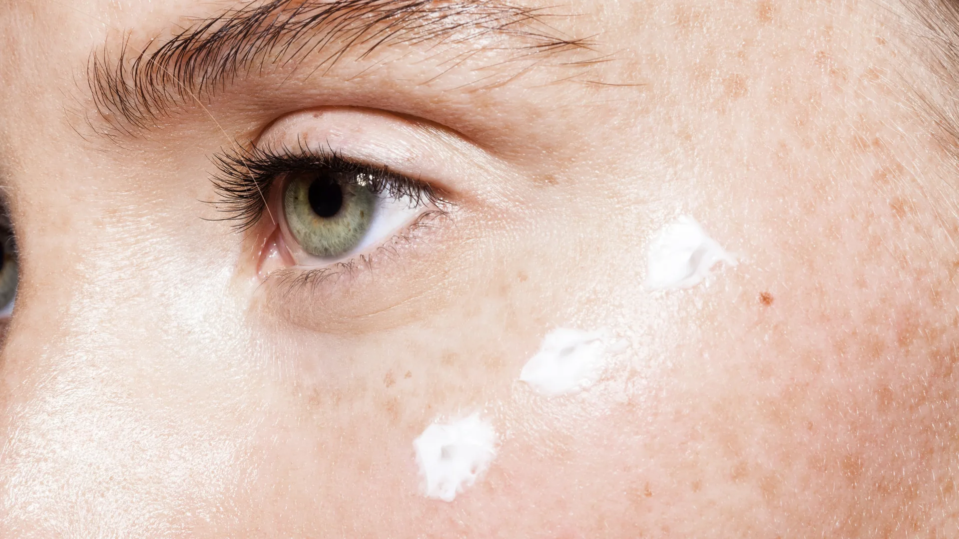 Microneedling manchas pecas faciales