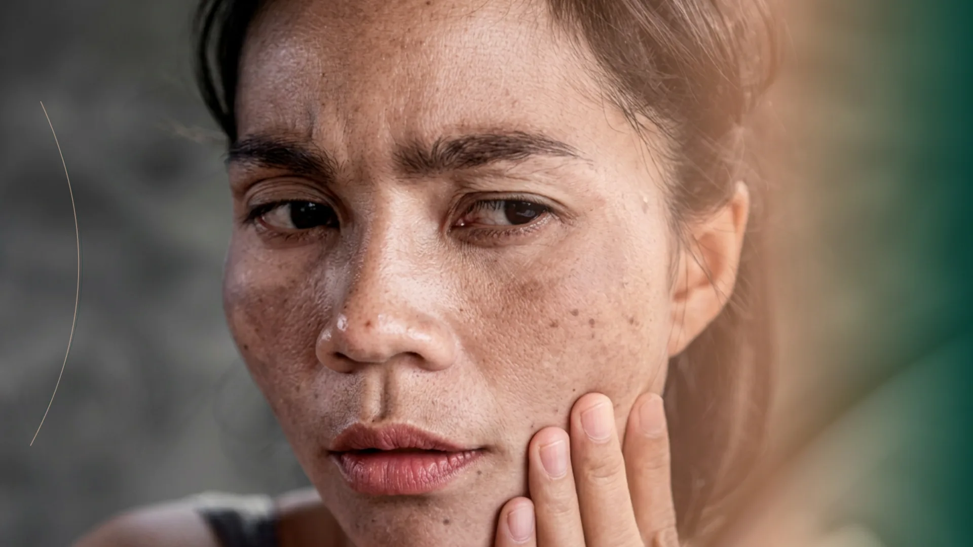 Microneedling manchas piel mujer