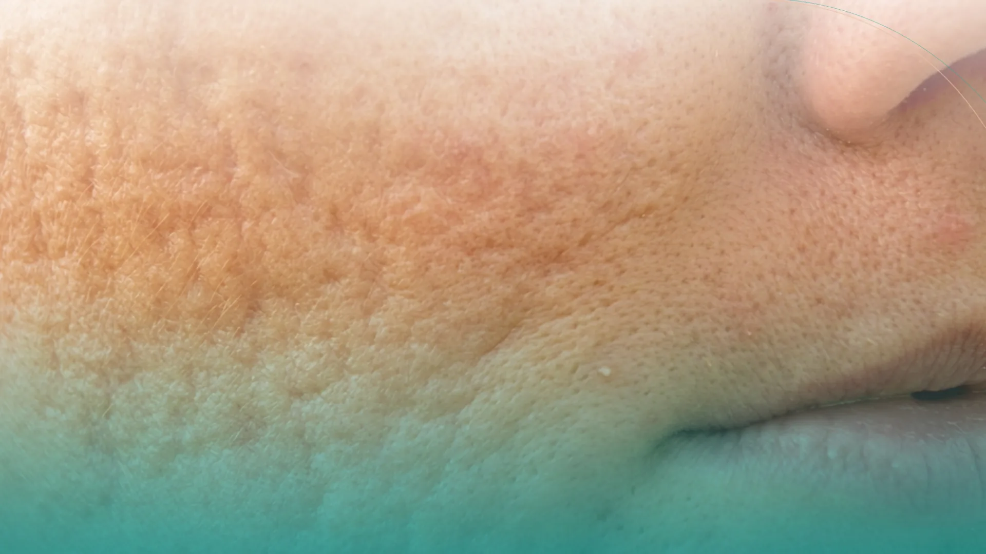 Microneedling manchas postinflamatorias
