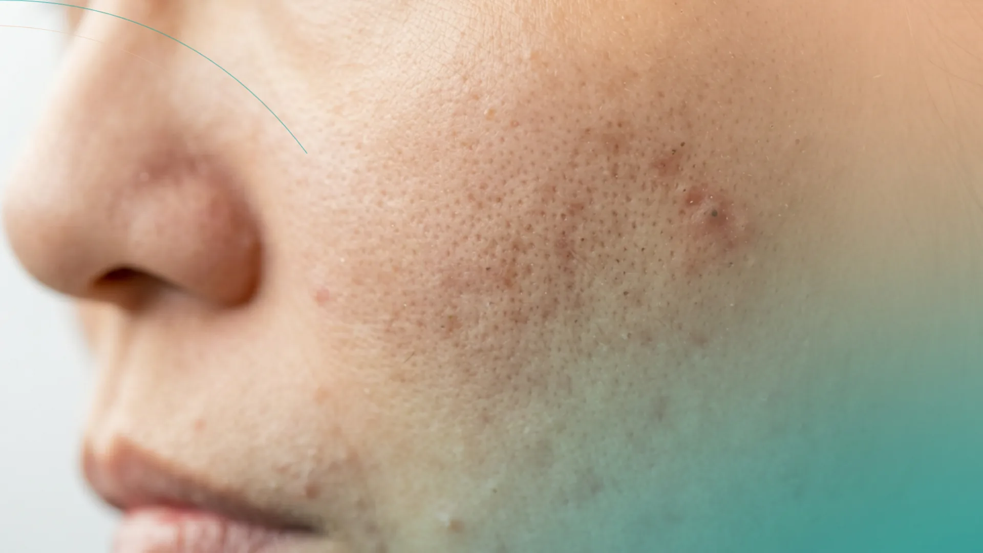 Microneedling poros y textura
