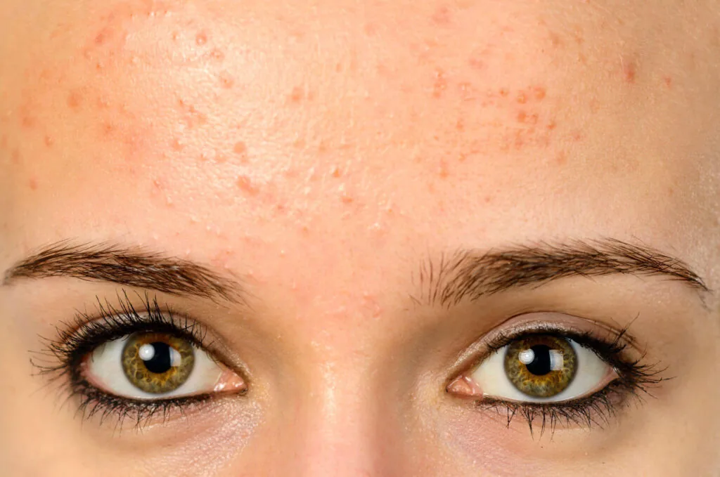 Adiós a las Espinillas en la Cara con Microneedling