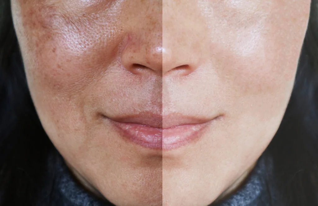 Dermapen para Hiperpigmentación: ¿Funciona?