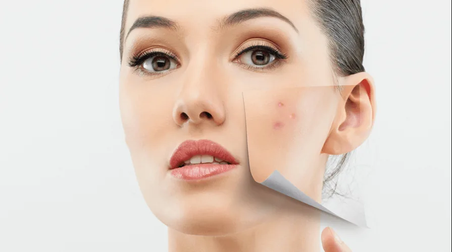 Los Beneficios del Dermapen para Tratar las Cicatrices de Acné