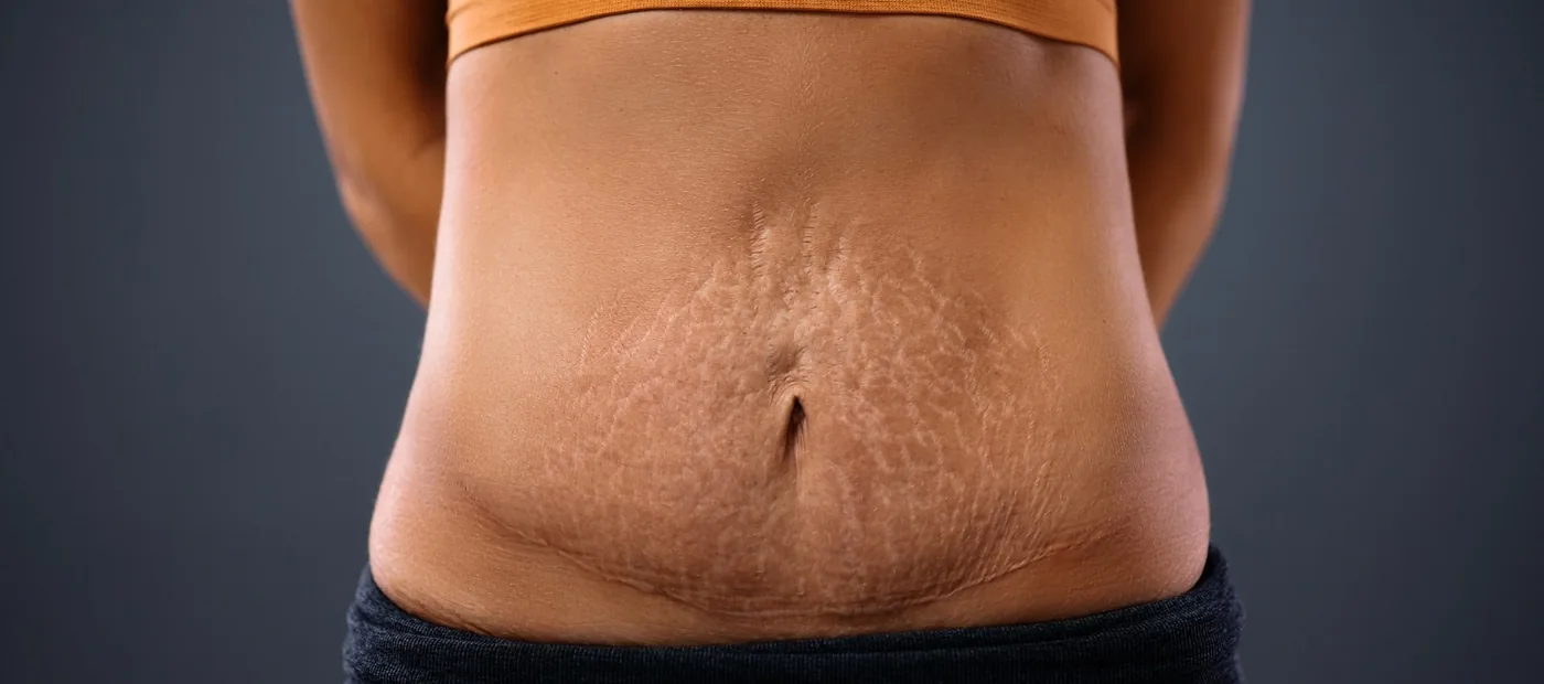 Microneedling para eliminar las Estrías Rojas y las Estrías Blancas.