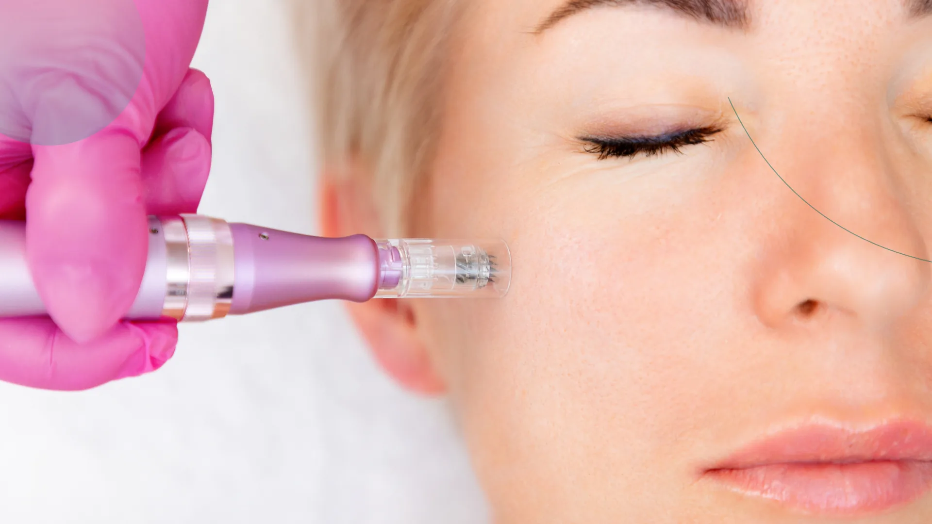 Microneedling para rejuvenecimiento y firmeza facial en Sant Cugat del Vallès