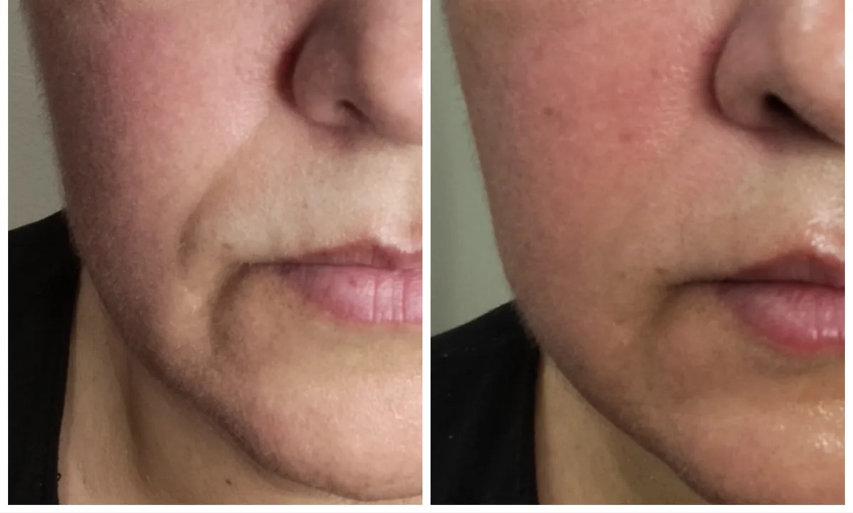 Antes y después de microneedling en Synergia Salud & Bienestar