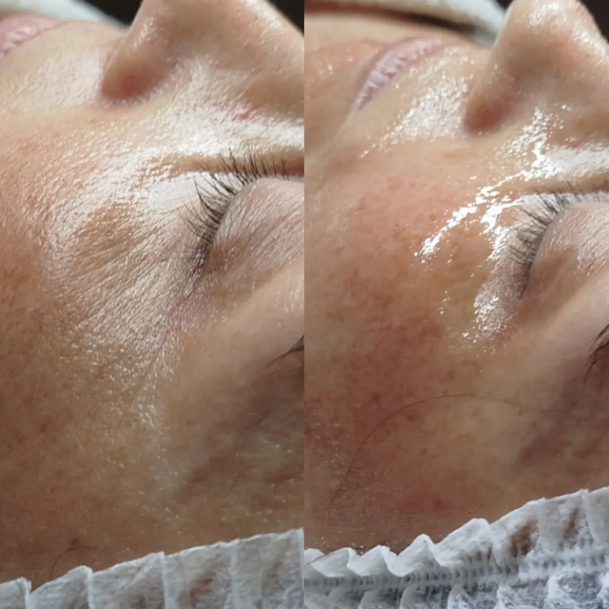Antes y después de microneedling en Synergia Salud & Bienestar