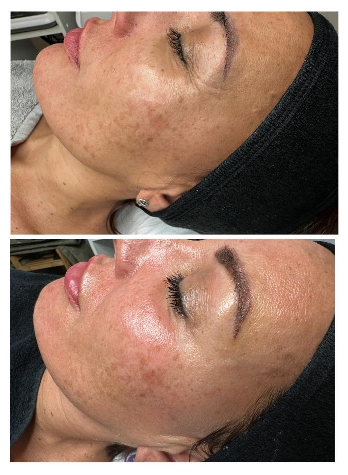 Antes y después de tratamiento de microneedling profesional para cicatrices de acné realizado en Harmony Esthetic Spa en Madrid.