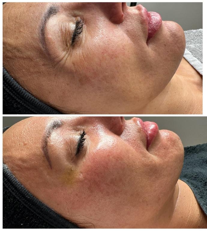 Resultados reales de microneedling con Dermapen para mejorar la textura de la piel con marcas de acné en Madrid.