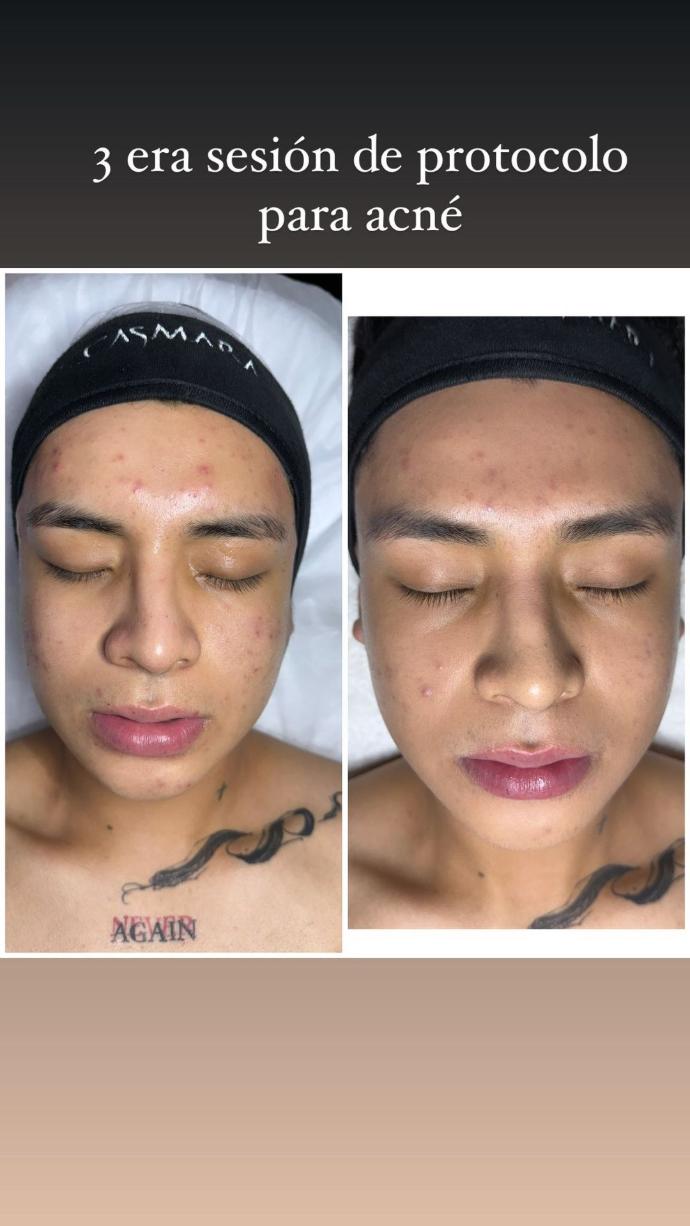 Resultados progresivos tras varias sesiones de microneedling profesional con diagnóstico previo en Harmony Esthetic Spa, Madrid.