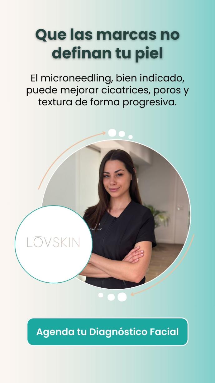 Microneedling en Barcelona para Cicatrices de Acné