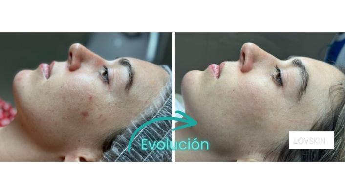 Microneedling para cicatrices. Antes y después.