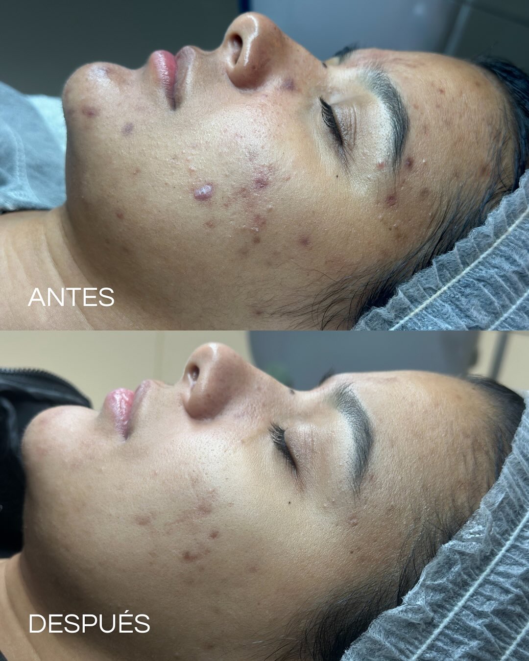 Resultados reales de microneedling profesional para mejorar textura de la piel con marcas de acné en Barcelona.