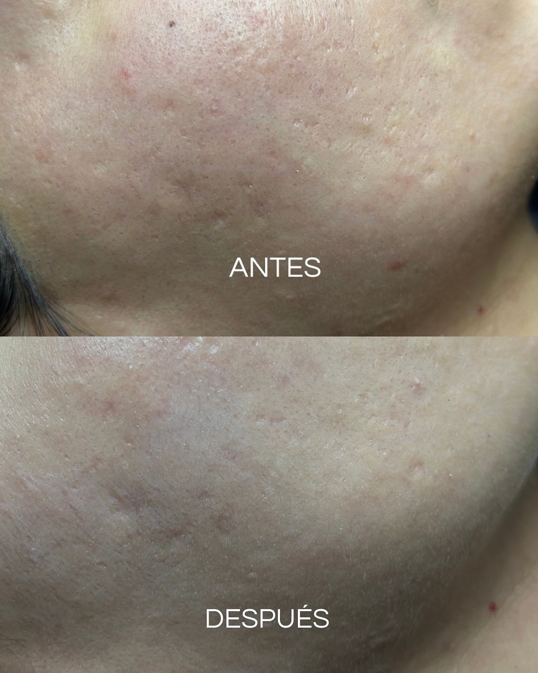 Resultados progresivos tras varias sesiones de microneedling profesional en Lovskin Barcelona con estimulación de colágeno.