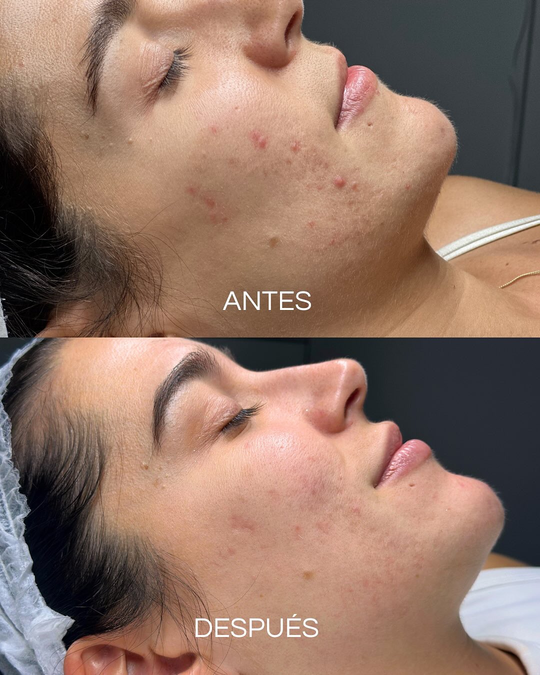 Resultados reales de microneedling profesional para mejorar textura de la piel con marcas de acné en Barcelona.