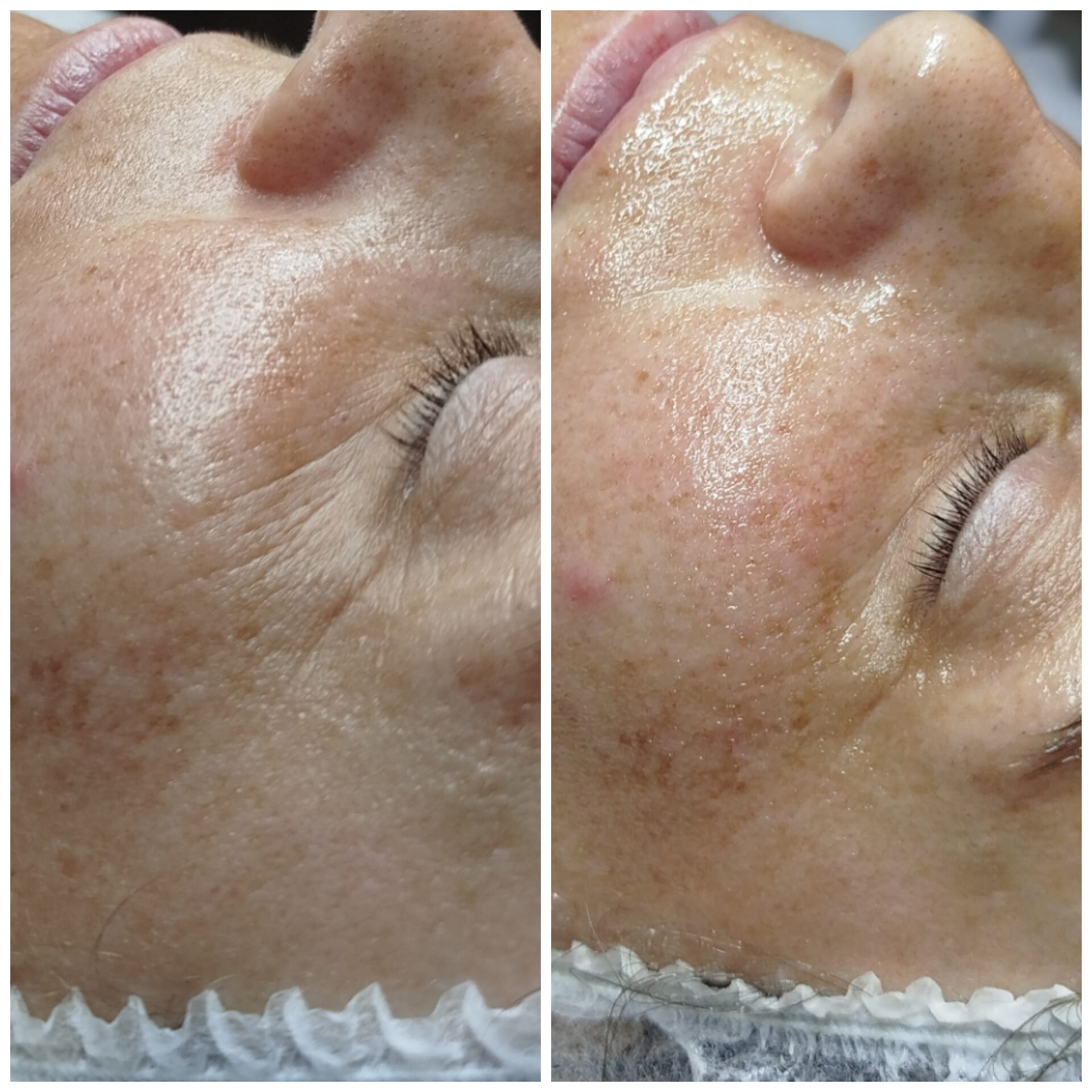 Aplicación de microneedling para estimular colágeno y reducir arrugas en Synergia Salud & Bienestar, Almería.