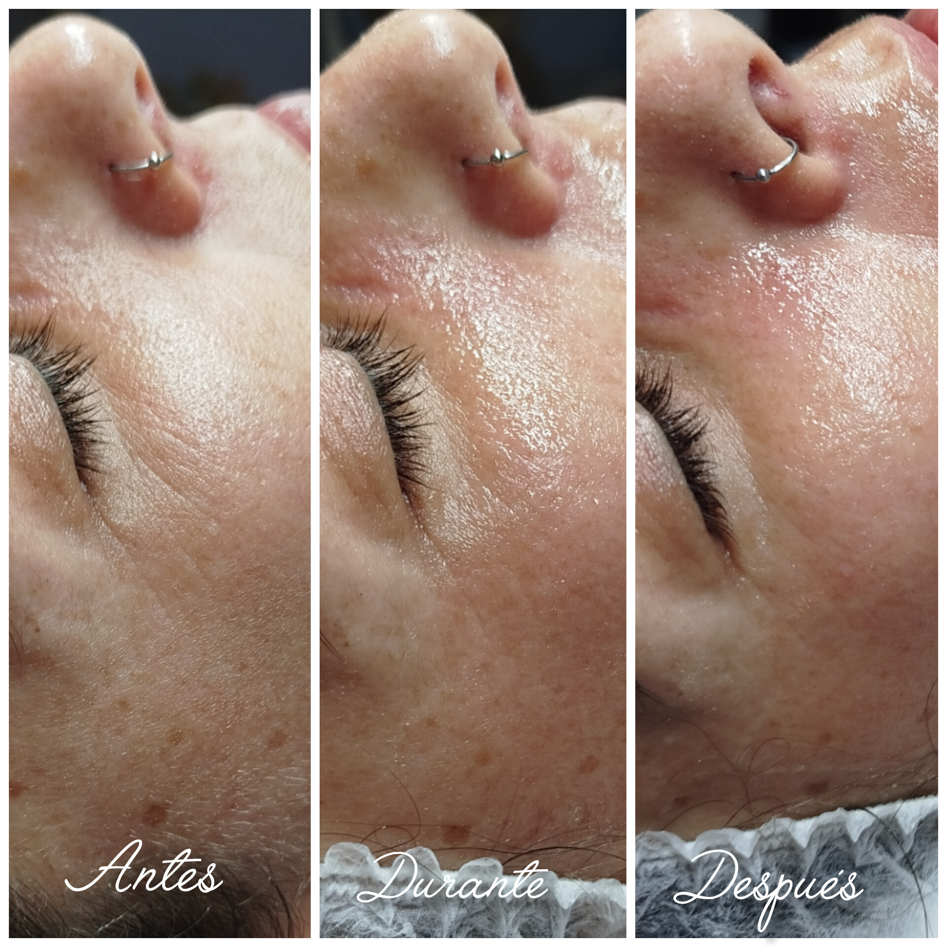 Antes y después de tratamiento profesional para reducción de arrugas realizado en Synergia Salud & Bienestar en Almería