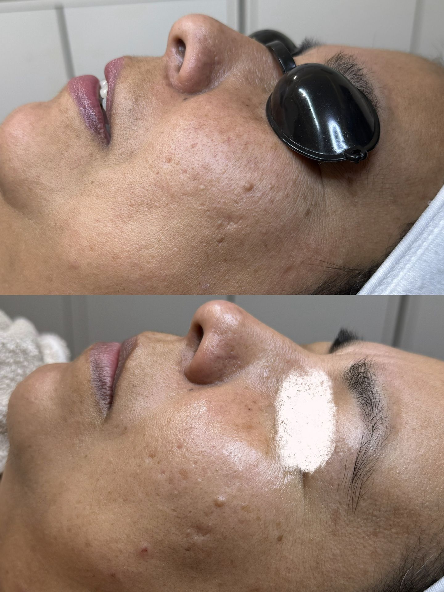 Valoración personalizada de la piel antes de iniciar tratamiento de rejuvenecimiento facial en Barcelona