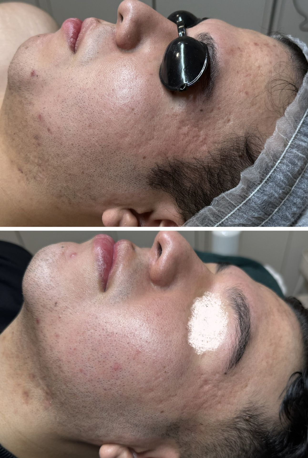 Aplicación de microneedling profesional para estimular colágeno y mejorar firmeza facial en Barcelona.