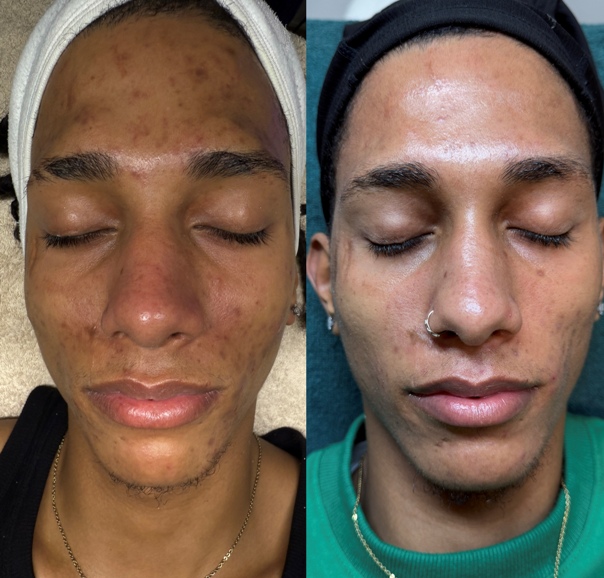 Mejora de tonicidad y elasticidad tras tratamiento de firmeza facial en Barcelona.