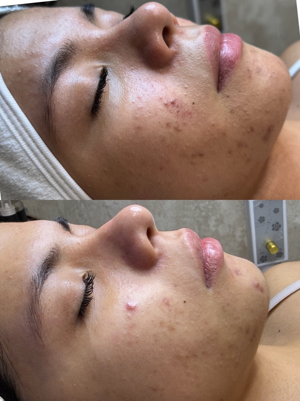 Antes y después de tratamiento de rejuvenecimiento y firmeza facial realizado en Empathy centro de estética avanzada en Barcelona.