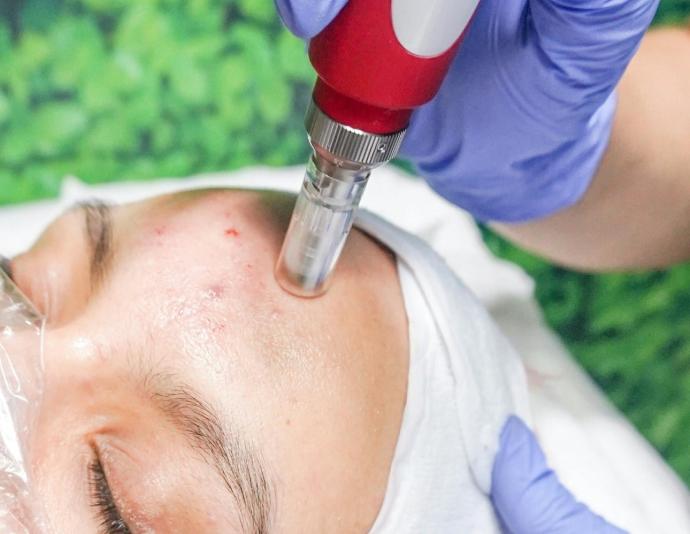 Red de Centros de Microneedling en Valencia